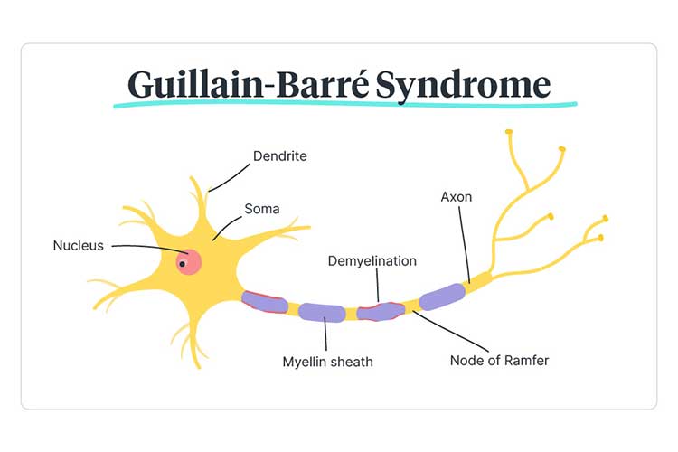 Guillain-Barré Syndrome Wiki