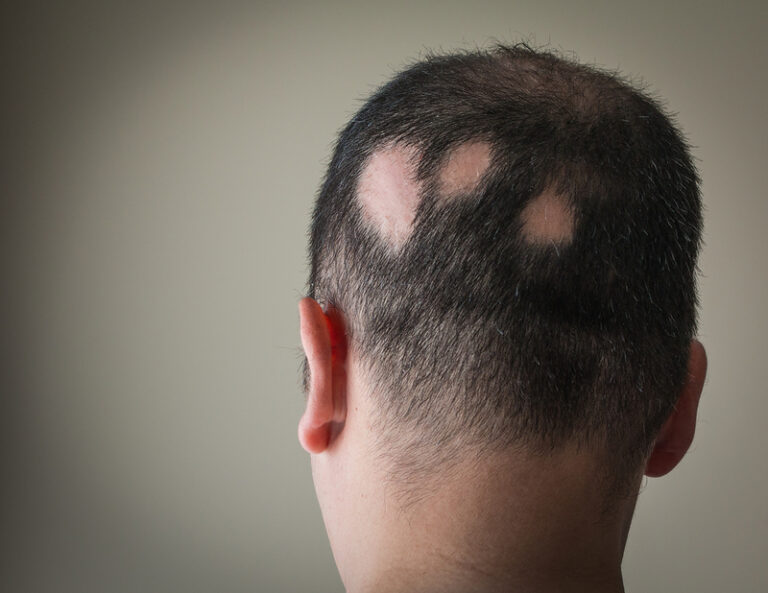 Alopecia Treatment Pfizer