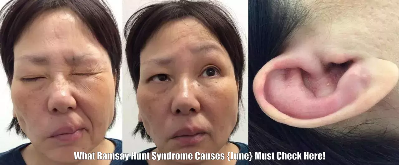 What Ramsay Hunt Syndrome Causes