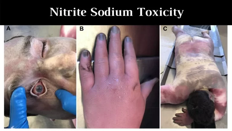 Nitrite Sodium Toxicity
